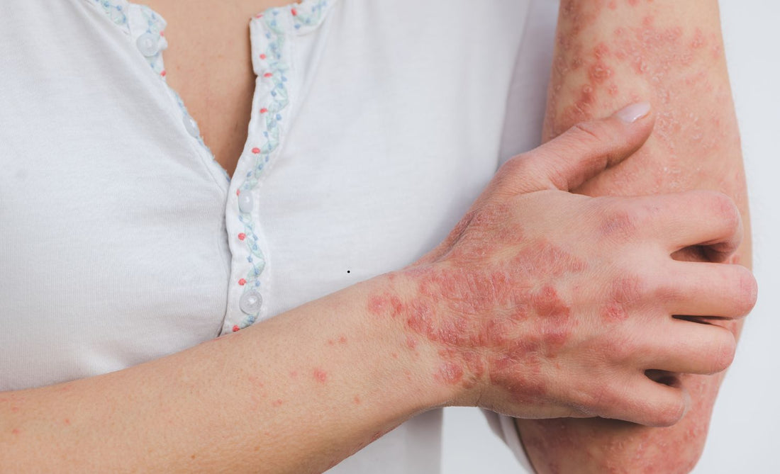 Is your Skin Pealing. This could be the solution!