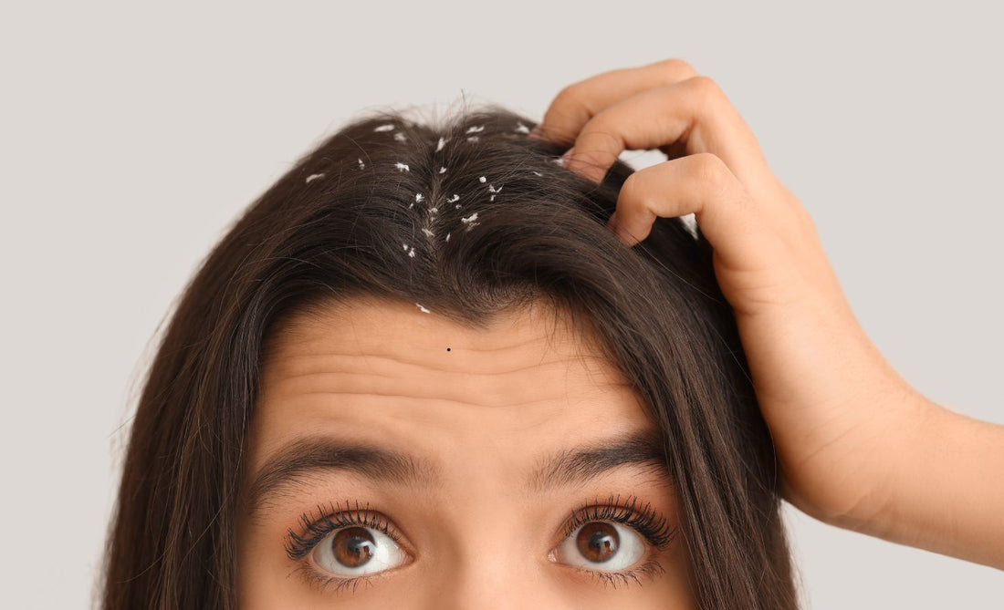 Say Goodbye to Dandruff with These 7 Ayurvedic Remedies