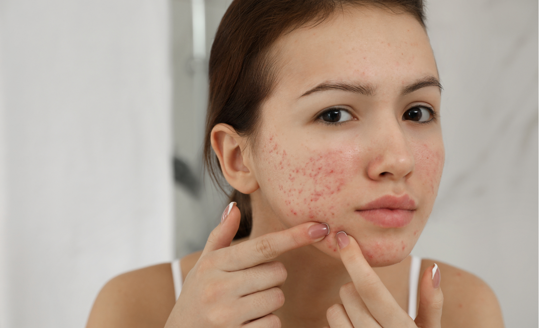 Woman with acne