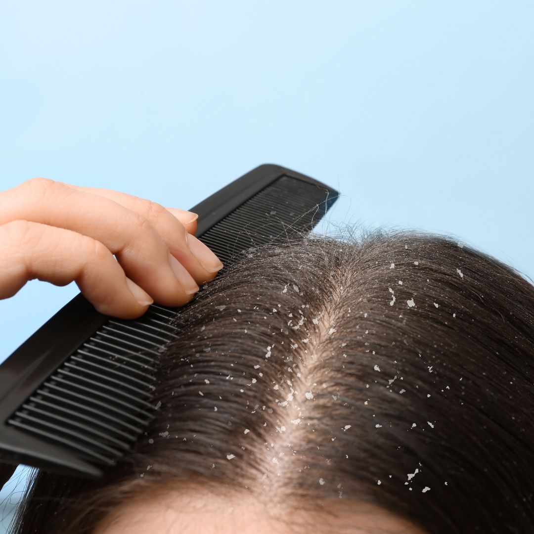 Is dandruff affecting your day to day life? Read how you can overcome it