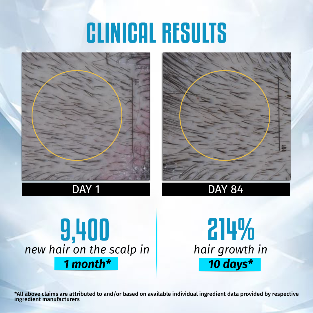 90 Days Hair Regrowth Kit for Men