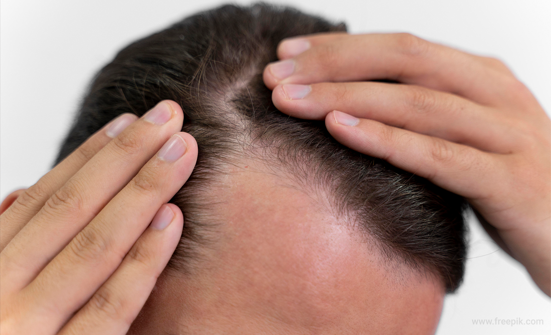 Facing Hair Thinning? Understand its cause and cure with Ayurveda.