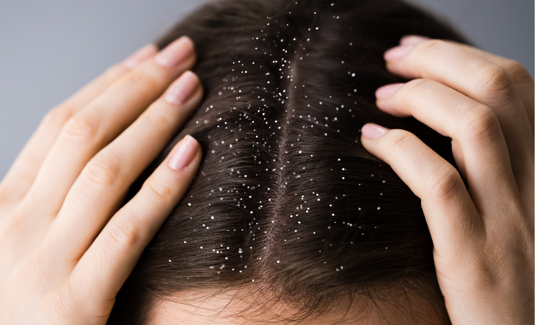 5 Effective Tips to get rid of Dandruff in monsoon