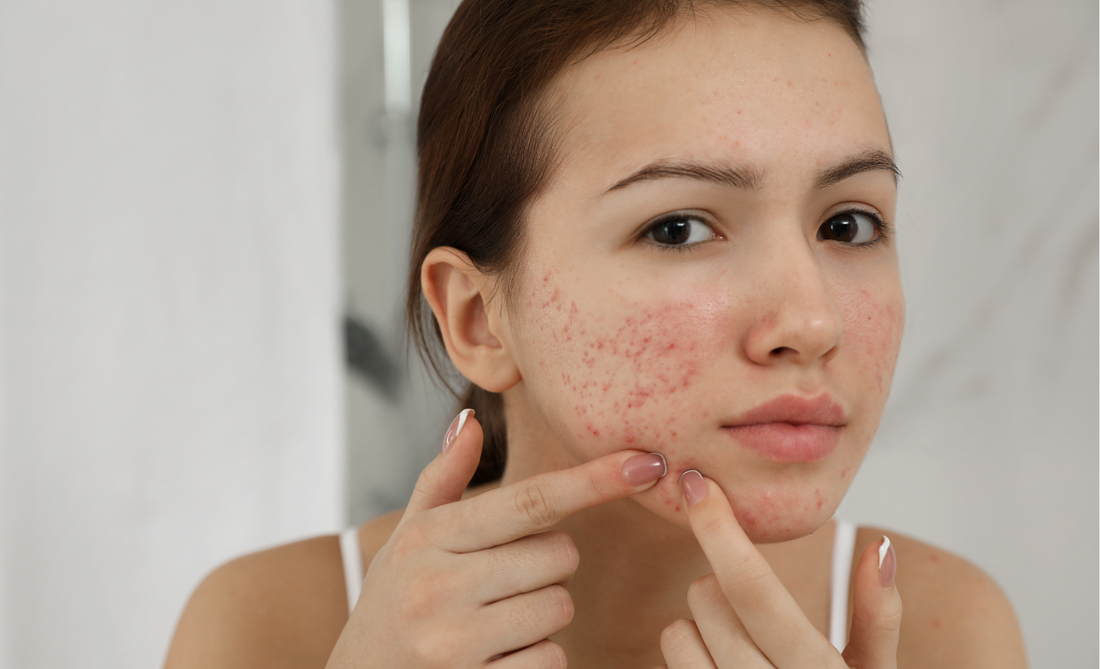 What causes pimples and how to treat them