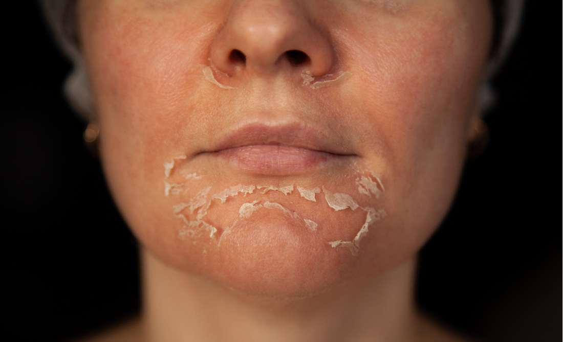 Why is my skin peeling and what is the solution. ( 1 minute Blog)
