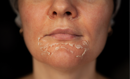 Why is my skin peeling and what is the solution. ( 1 minute Blog)